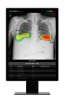 Lunit INSIGHT CXR Excels in Lung Nodule Detection – Exceptional Performance in Head-to-Head Study published in Radiology