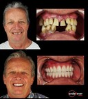 Dental Tourism | The Best Dentists Option in Tijuana Mexico – Smile 4 Ever Mexico